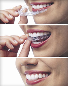 Woman Using Invisalign Teeth Aligners - The Fort Collins Dentist