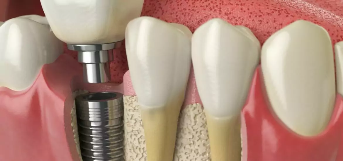 Titanium Dental Implant - The Fort Collins Dentist