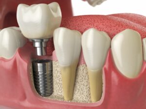 Titanium Dental Implant - The Fort Collins Dentist