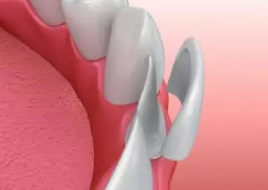 Porcelain Dental Veneers illustration at The Fort Collins Dentist