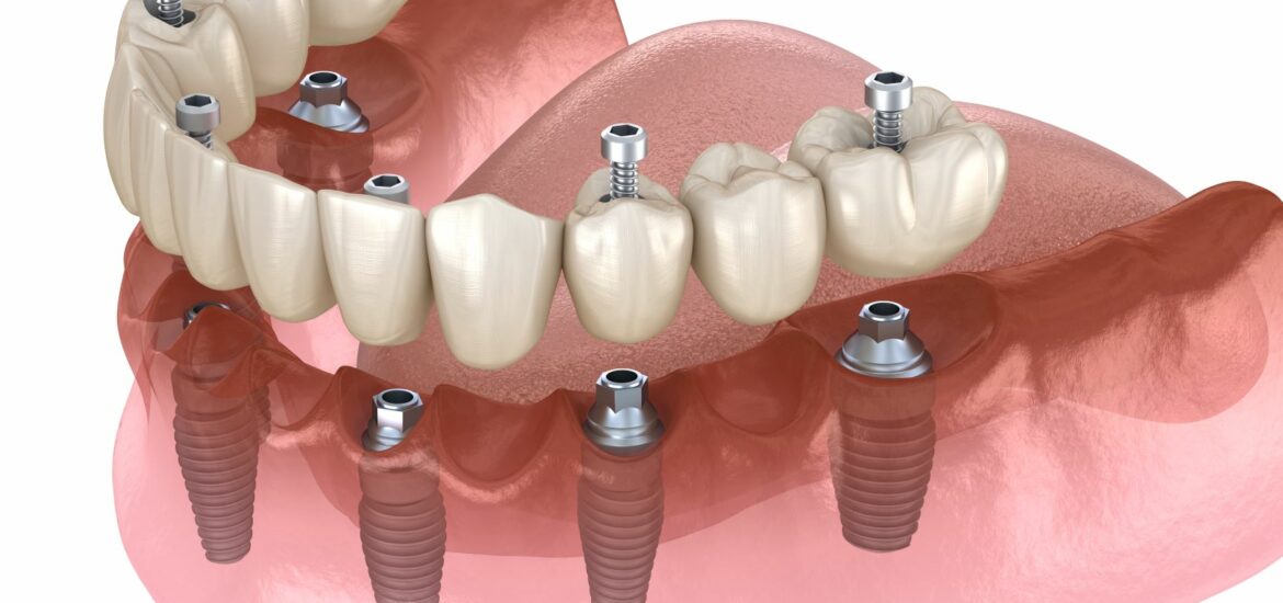 Permanent Implant Dentures - The Fort Collins Dentist