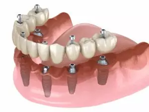 Permanent Implant Dentures - The Fort Collins Dentist