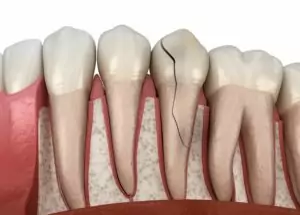 Cracked Tooth Repair Fort Collins CO