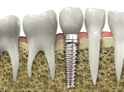 A graphic image of a dental implant placed in a jawbone.